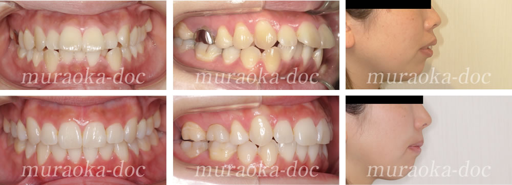 大人の上下顎前突の矯正治療例(期間1年8ヵ月)