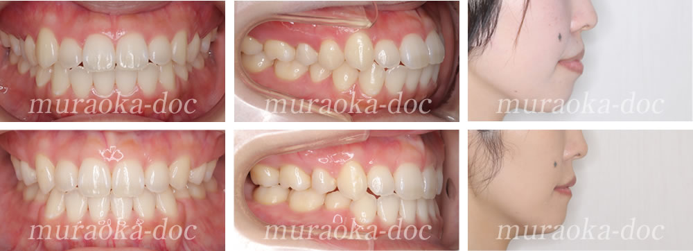 大人の上下顎前突の矯正治療例(期間1年10ヵ月)