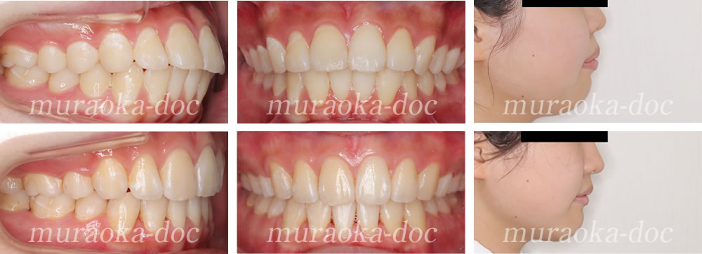 大人の上下顎前突・出っ歯の矯正治療例(期間1年10ヵ月)