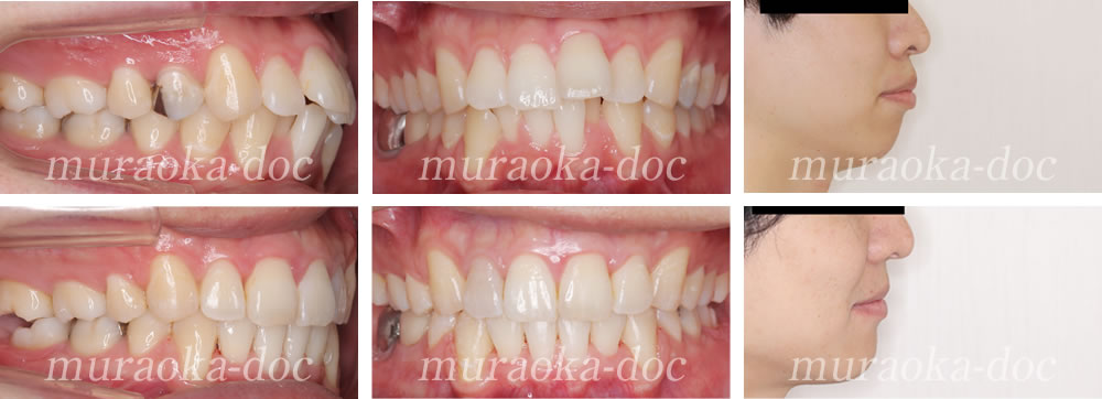 大人の上下顎前突・出っ歯・叢生の矯正治療例(期間1年11ヵ月)