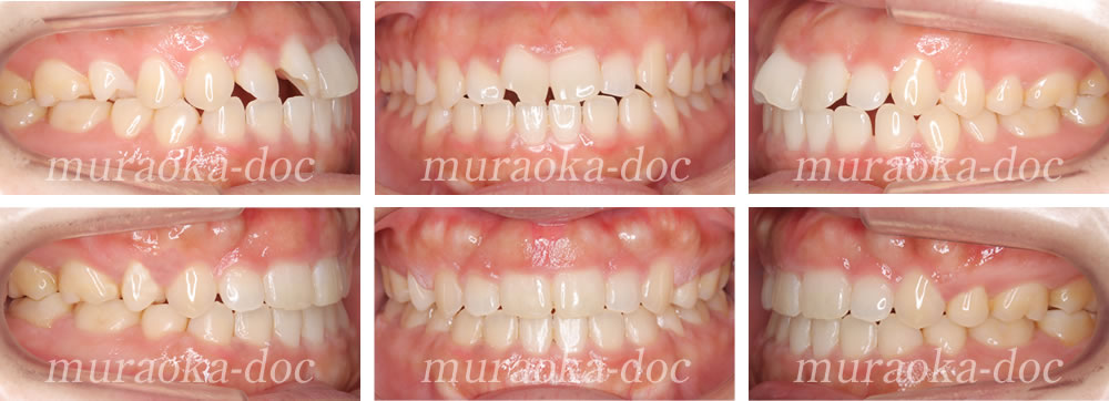大人の上下顎前突・叢生の矯正治療例(期間1年10ヵ月)