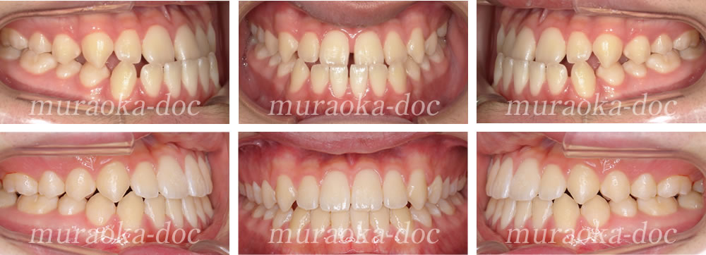 大人の下顎前突・受け口の矯正治療例(期間1年6ヵ月)