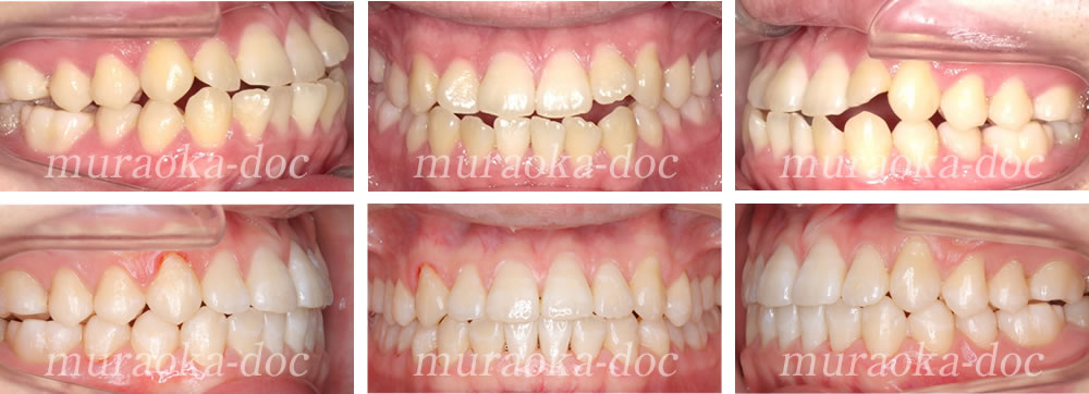 大人の受け口・叢生・開咬の矯正治療例(期間1年3ヵ月)