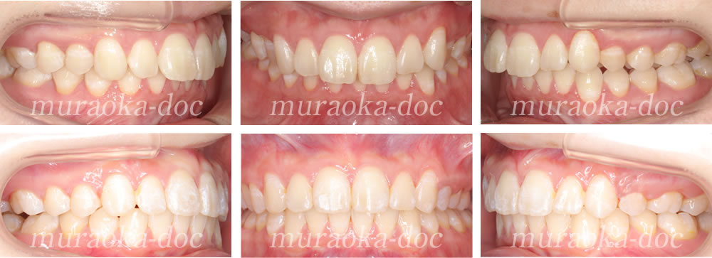 大人の過蓋咬合・叢生の矯正治療例(期間1年7ヵ月)
