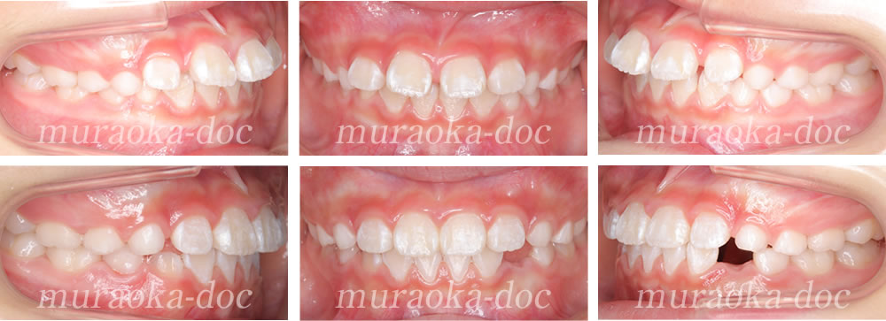 子どもの出っ歯・過蓋咬合・すきっ歯の矯正治療例(期間1年1ヵ月)