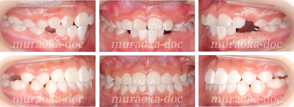 子どもの受け口・叢生の矯正治療例(期間1年3ヵ月)
