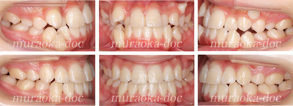 大人の叢生・凸凹・八重歯の矯正治療例(期間2年1ヵ月)