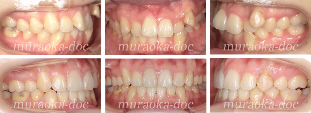 大人の叢生・八重歯・過蓋咬合の矯正治療例(期間1年9ヵ月)