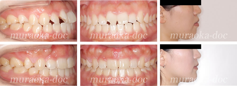 大人の上下顎前突・叢生の矯正治療例(期間1年8ヵ月)