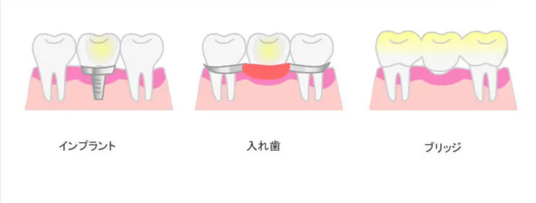 【歯を失ったときの選択肢：インプラント・ブリッジ・入れ歯の違いとは？】