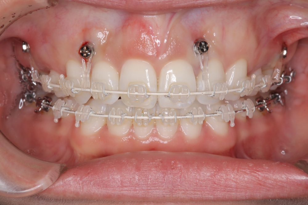 ガミースマイル