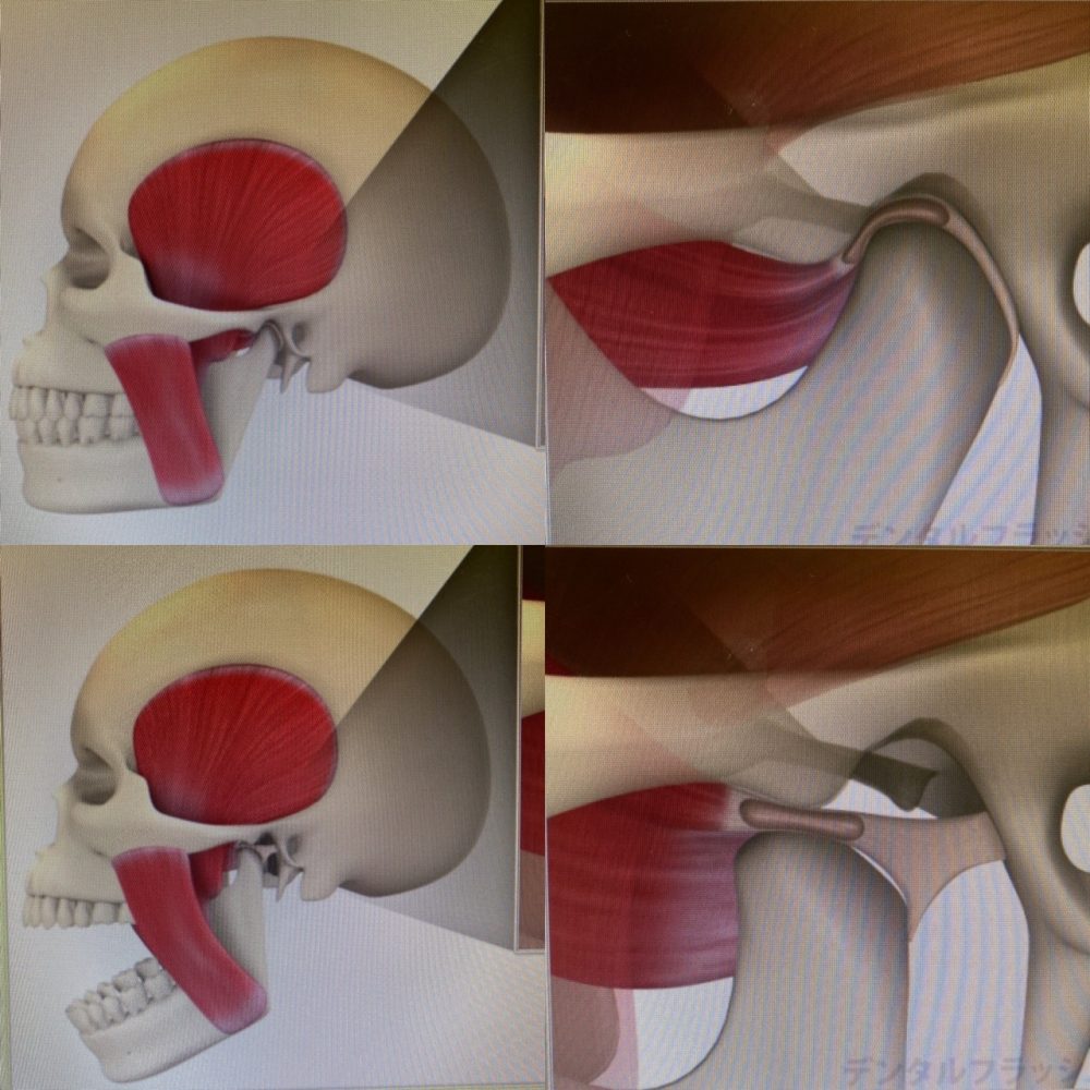 顎がカクカクいって痛い 市川市本八幡のむらおか歯科 矯正歯科クリニック