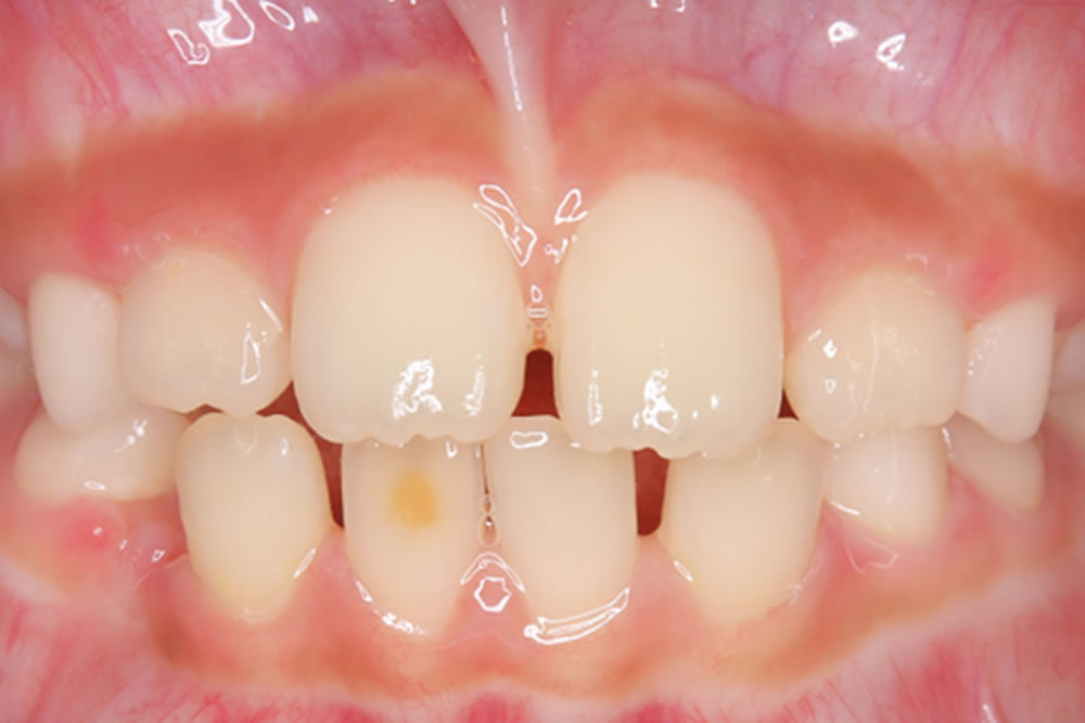 すきっ歯・空隙歯列